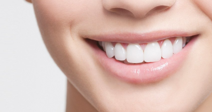 The Best Option for Smile Makeover – Different Types of Veneers