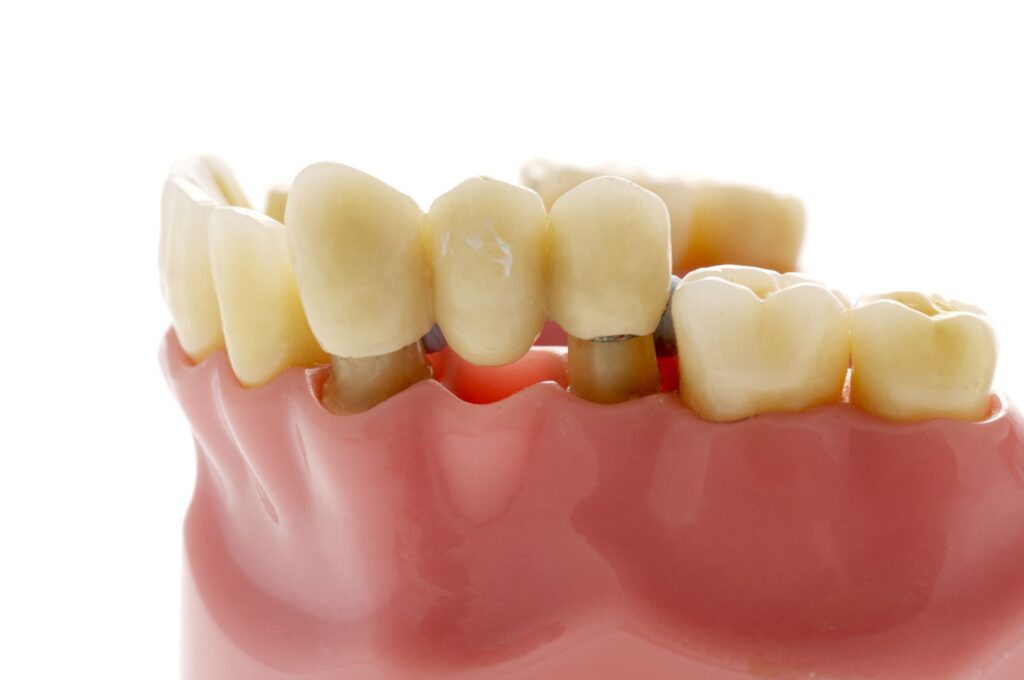 Advantages of a Dental Bridge