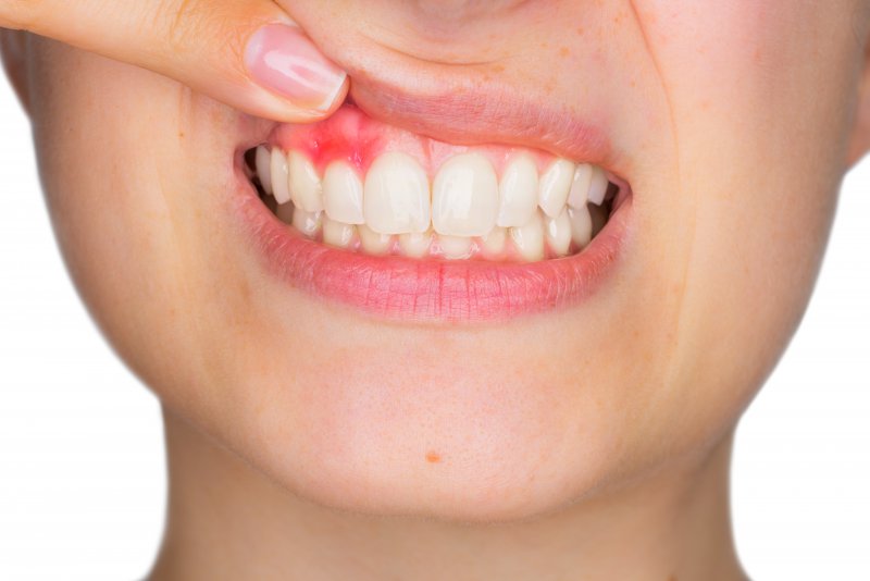 How to Determine Whether You Have Gum Cancer or Gingivitis?