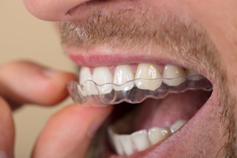 What to Expect If You Have TMJ Disorder and after You Get Treatment in Los Gatos
