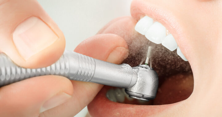 When Do You Need Dental Restoration?