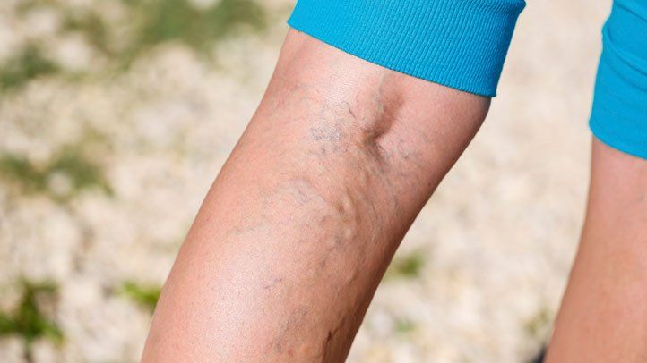 Varicose Veins- How Can You Deal with them in Your Daily Life