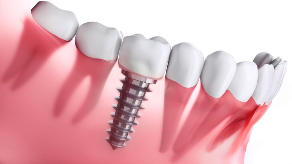 How to Take Care of Your Dental Implants?