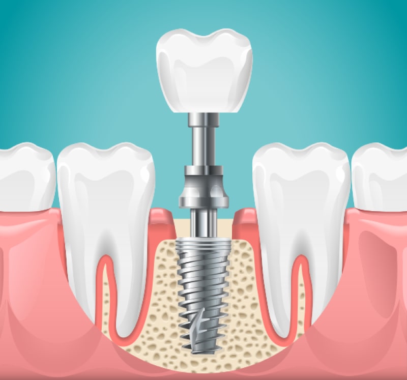 Dental Implants in Maryville: Taking Advantage of their Stability and Improving Your Jawbone Health