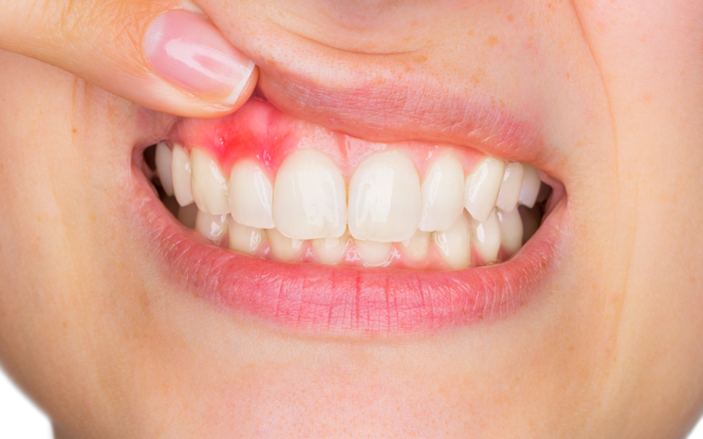 Practice These Tips To Prevent Gingivitis 