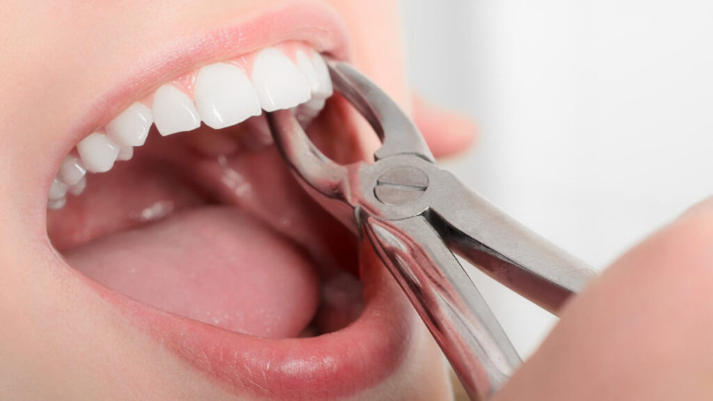 Tooth extraction 101: The procedure, what to expect, and more