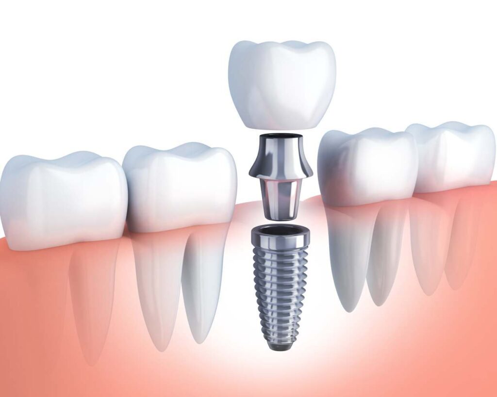 5 Reasons for Getting Dental Implants