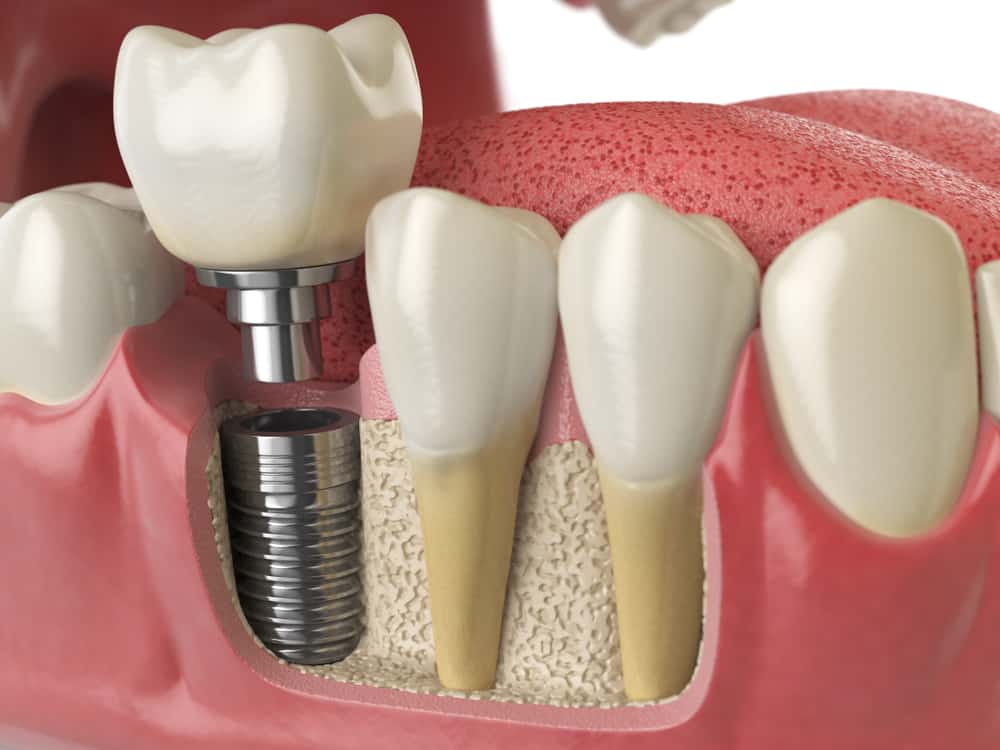 Bridges Offer Numerous Choices for Tooth Replacement