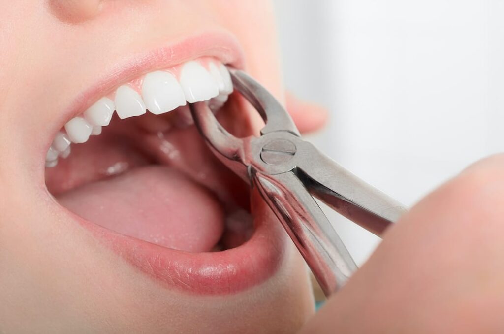 When is Tooth Extraction Recommended? 