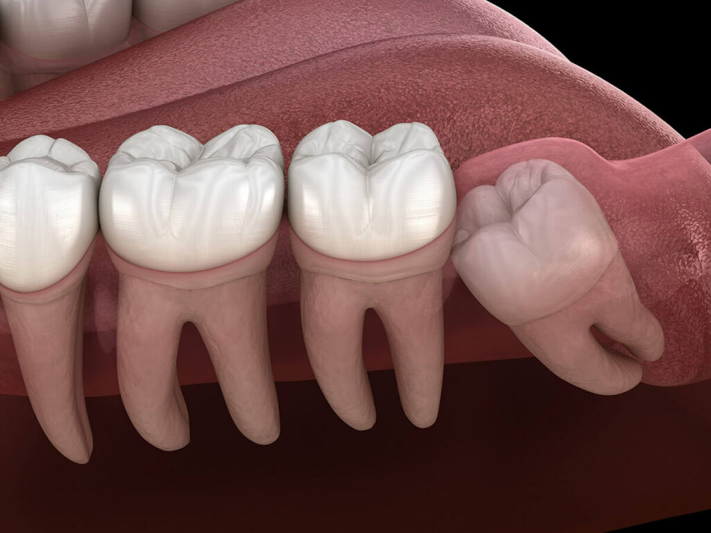 What to Do When Your Wisdom Tooth is Impacted in Mooresville, NC?