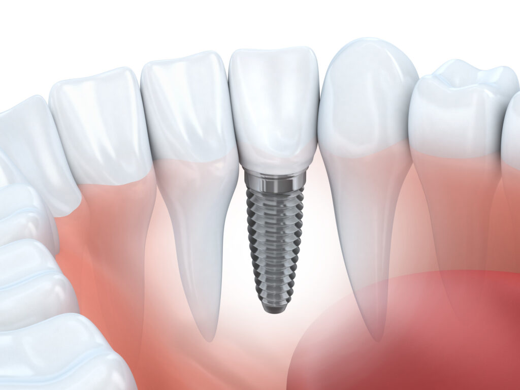 Significance of Root Canal Therapy