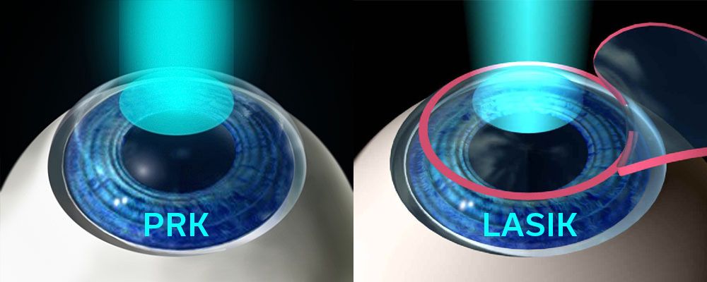 All About LASIK: Breaking Down the Differences with PRK
