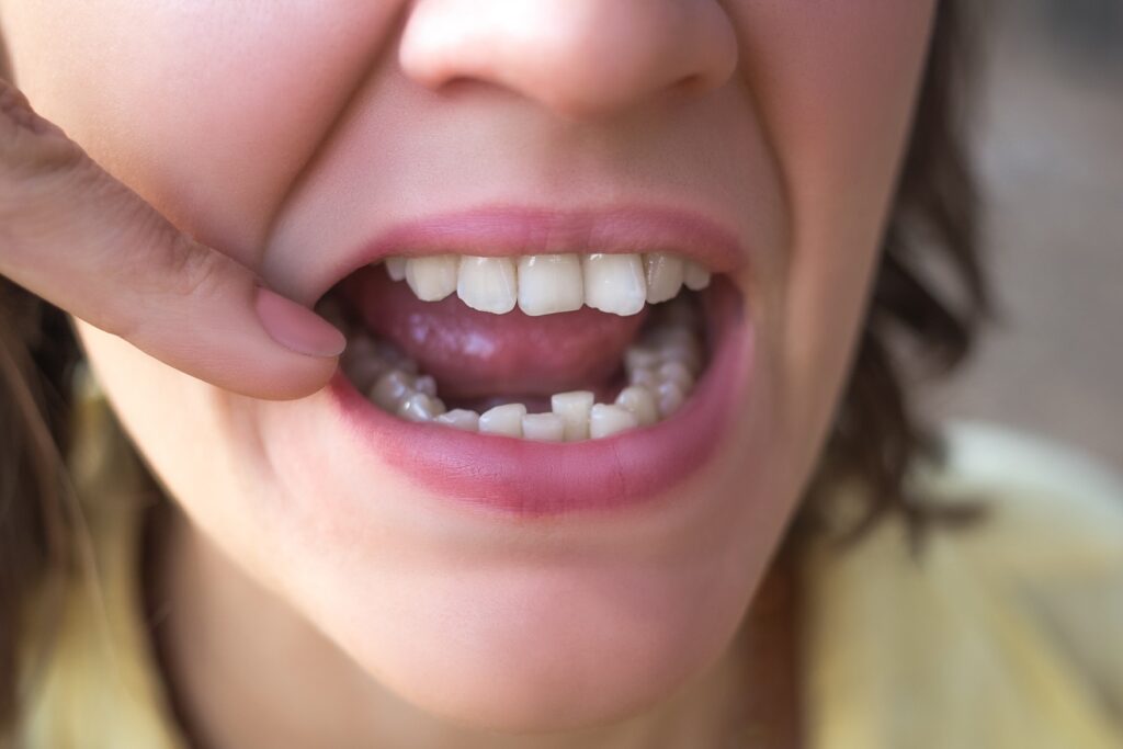 Is Crowding Bad for Your Teeth?