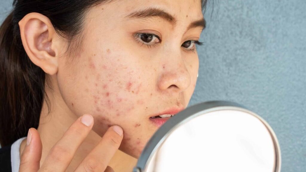 The Evolution of Acne Treatment in Singapore