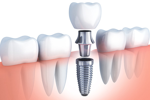 Dental Implants: A Permanent Solution to Missing Teeth