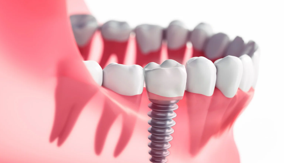 How Dental Implants Improve Your Health as Well as Your Smile?