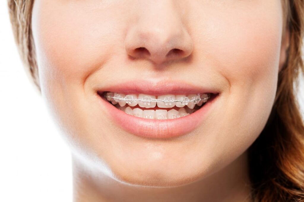 Top 5 Advantages of Orthodontic Treatment