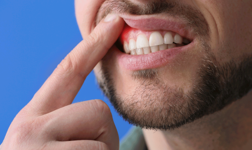 Periodontitis: Causes, Symptoms, And Treatment