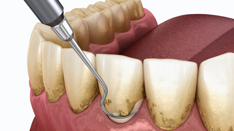 Pocket Irrigation: A Key Component of Periodontal Therapy