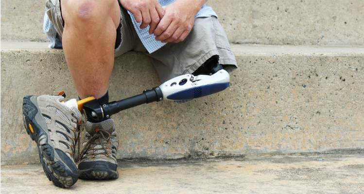 Comprehensive Guide to Above Knee Prosthetic Legs: Features and Components