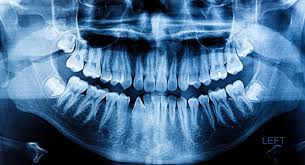 Unveiling the Mystery of Dental X-rays 