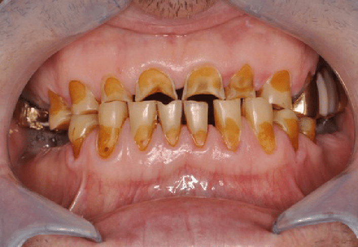 Tooth Erosion: Definition and Causes