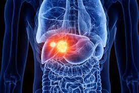 A New Hope for Patients: Exploring Aplastic Anemia Homeopathic Treatment in India