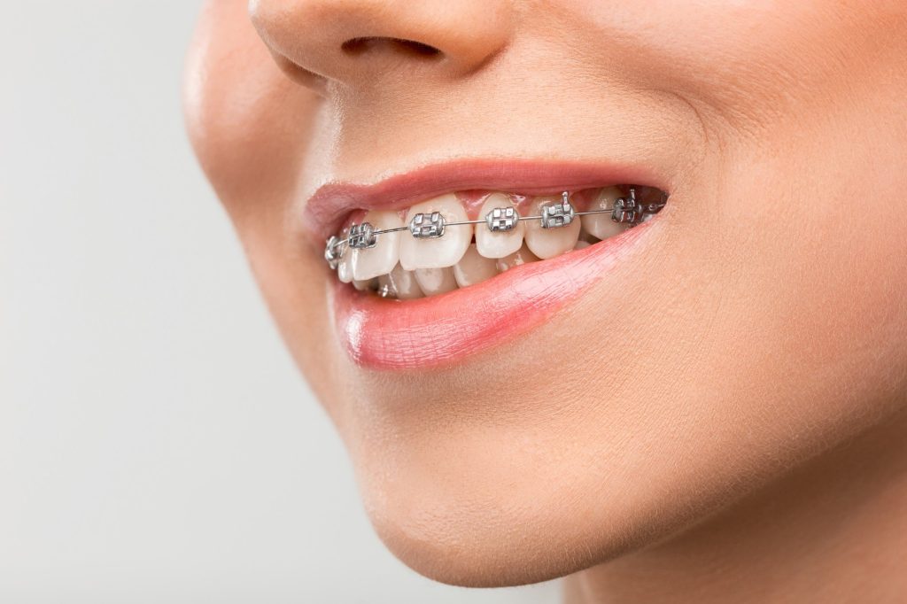 3 Signs It’s Time To Discuss Orthodontics With Your Dentist